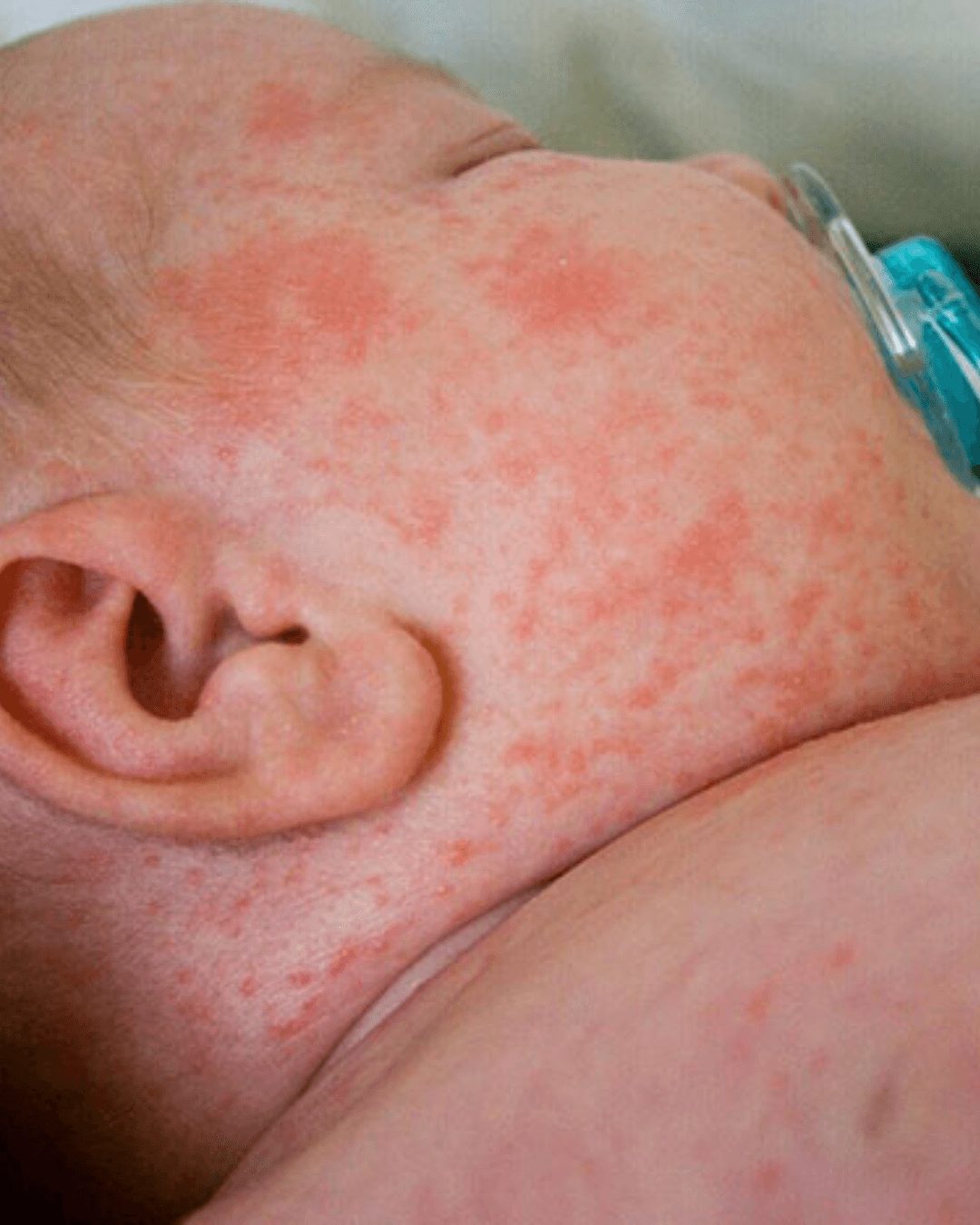 Niña con síntomas de APLV — dificultad para alimentarse